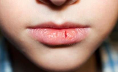 What Causes Chapped Lips?